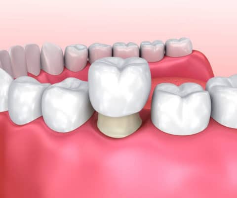 Cracked Teeth Treatment in Lisle, Illinois