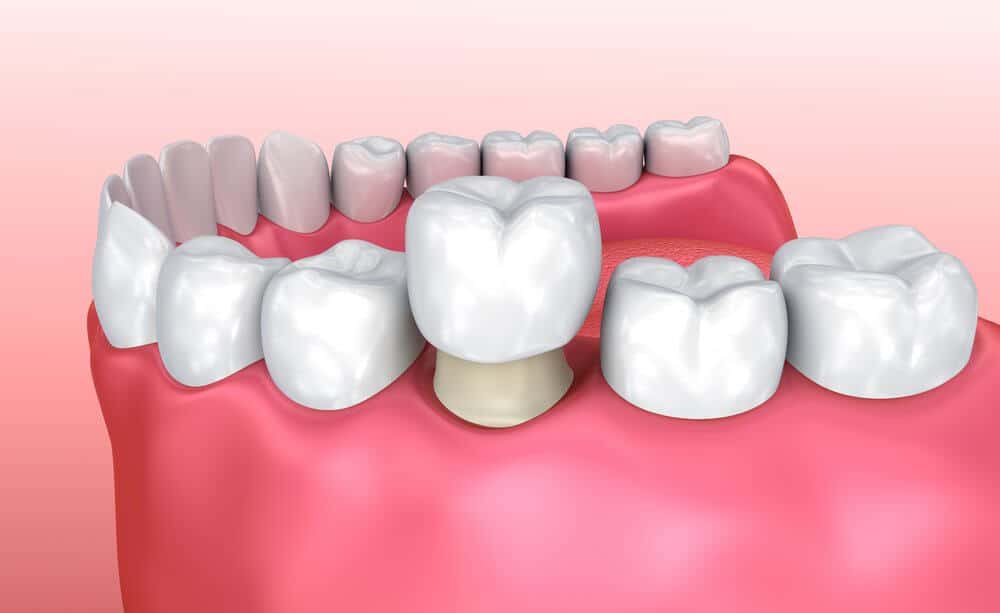 Cracked Teeth Treatment