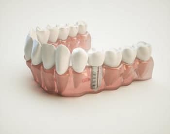 Dental Implants in Lisle, Illinois