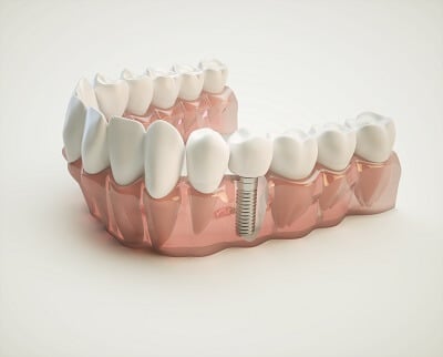 Root Canal Treatment in Lisle, Illinois